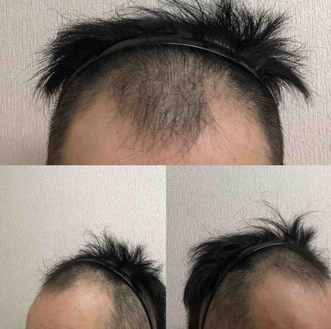 男女別 自毛植毛の治療経過ブログまとめ 自毛植毛ナレッジブログ 薄毛治療