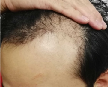 男女別 自毛植毛の治療経過ブログまとめ 自毛植毛ナレッジブログ 薄毛治療