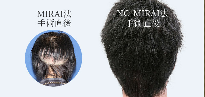 自毛植毛のおすすめ NC-MIRAI法